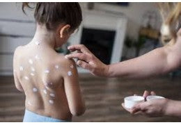 Cómo prevenir el contagio de la varicela en niños y familias