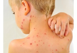 Cómo prevenir cicatrices de varicela en niños