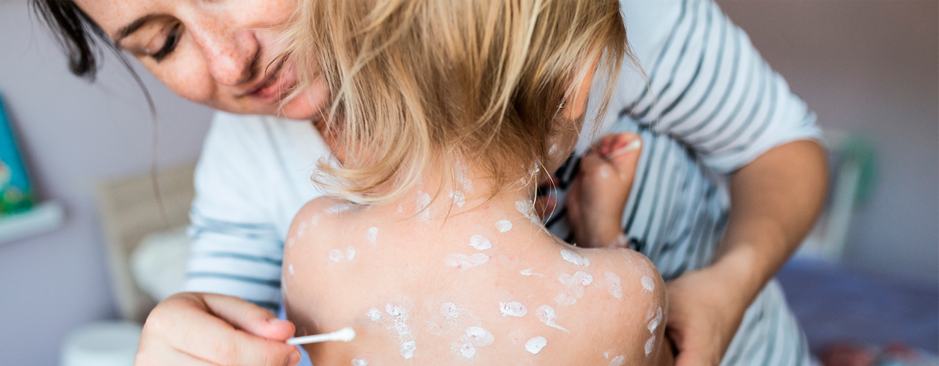 Cómo aliviar el picor de varicela: Guía definitiva para padres