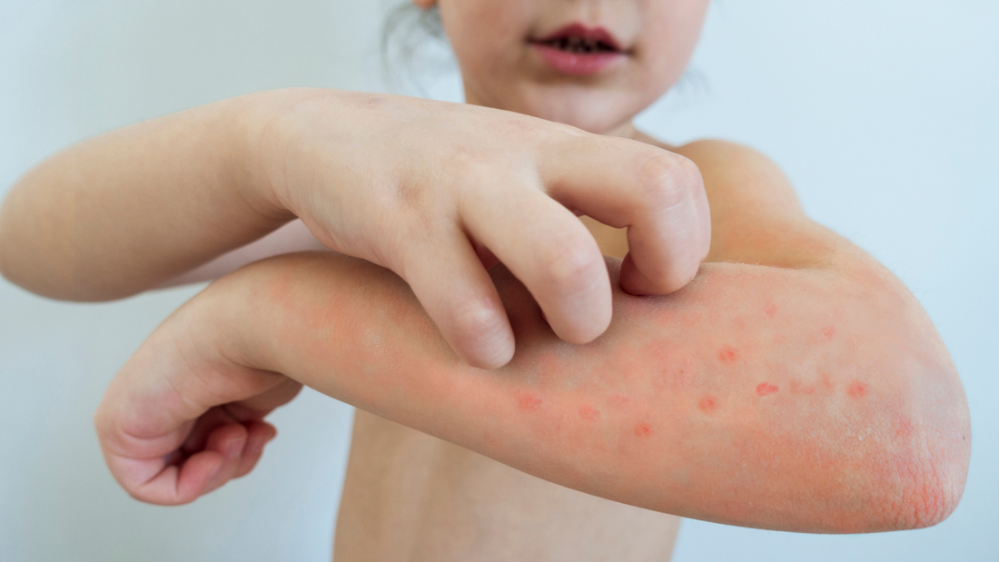 Cómo evitar que los niños con varicela se rasquen la piel