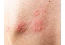 Qué es el herpes zóster y por qué es varicela latente